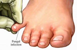 foot fungus fungal infection athlete foot