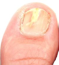 foot fungus types infected toenail