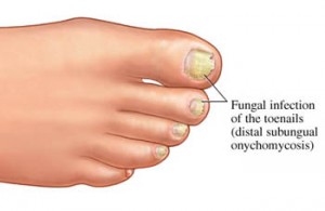nail fungus toes onychomycosis