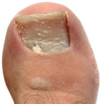 superficial onychomycosis type