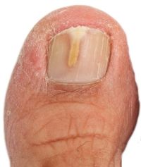 toenail fungus early stages beginning onychomycosis symptoms
