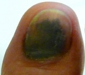 black toenail fungus onychomycosis fingernails treatment