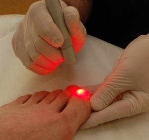 laser beam treatment toenail fungus