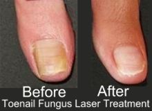 toenail fungus laser treatment before after care 