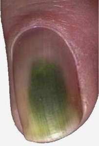 green nail syndrome nail fungus